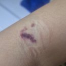 4uPC | [ IgA신증 ] 사구체신염 스테로이드(소론도정 4알) 복용기(~11주차)