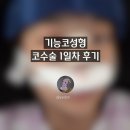 비염코수술 - 01 무보형물 수술의 모든 것 : 내돈내산 후기