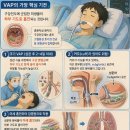 "혹시 VAP을 아세요?" - 인공호흡기 관련 폐렴의 정의, 원인, 임상 양상, 그리고 항생제 치료