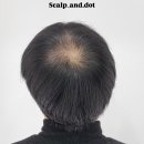 시흥 은계지구 두피문신 탈모케어 5회차 실제 후기