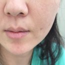 부산 쥬베룩 볼륨 내돈내산 후기, 팔자주름 부산피부과 추천