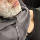 손**-2 | 부산 리쥬란힐러 2cc 손주사 2주 솔직후기｜속건조 개선, 엠보 경과