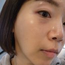 아그네스 | 한관종 제거 비용, 드디어 아그네스 3차 치료 후기