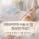 보라멍 | 전방십자인대 수술 후기 4편 | 전방십자인대 수술 후 멍 정상인가요? 상처와 멍 변화 1~3주 실제 후기