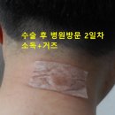 산본항외과의원 | 뒷목 표피낭종 제거 수술비용 및 병원 수술절차 후기