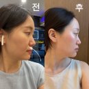 신사 올타이트 400샷 맞고 하프해진 이중턱 피부클리닉 후기 (가격, 효과, 유지기간)