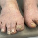 호평동발톱으로 소개하고싶은 &#34; 화이에스아카데미 &#34;에서 내성발톱관리받은 후기에요