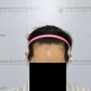 헤어라인 3600모 이식 이미지