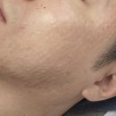 부스터 피부에 생기를 불어넣는 마법같은 힘, 밴스란힐러가 궁금하다? 화곡피부과 후기 민감성피부 부작용