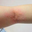 이유 없이 갑자기, 자주 생기는 만성 특발성 두드러기 원인과 관리법 (+치료 후기)