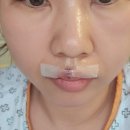 재건반점 | 치아파절 사고 후 1년간의 치료 입술 재건 성형수술 후기