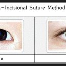 의료통역 실전편(중고급) 학습- 1장 눈수술의 종류 (매몰법) 이미지