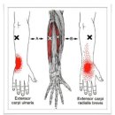 Extensor Carpi Radialis Brevis (단요측 수근신근) 이미지