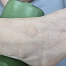 천자로 | 발등에 혹이 생겼다면? 결절종 초음파 천자 시술 후기