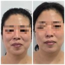 3775 | 미모다 뷰티 괴정점 하이 푸 V라인리 푸팅 관리 후기 영혼까지 끌어올려~~ 영끌리프팅