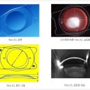 근시와 난시 모두 교정이 가능한 토릭 ICL 렌즈삽입술 | 이미지