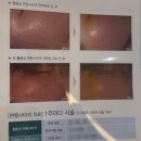 시중한의원 | 의정부 편평사마귀 제거, 비용·효과·회복까지｜피부과 한의원 솔직후기 &amp; 전후 사진포함!