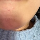 무량한의원 | 천안 지루성피부염 한의원에서 치료 받고 효과 제대로 본 후기 ><