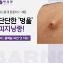 귀 뒤 멍울 귀뒤에 혹 부음 피지낭종 원인 왼쪽 오른쪽 귀뒤쪽 통증 어떤 이유일까 이미지