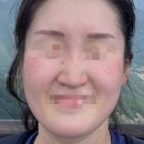 능곡하나내과의원 | 내돈내산 신부관리 능곡예인의원 기미·잡티 제거...2탄 얼굴 한판 사진후기 (병원 이전 위치 포함)