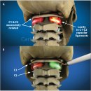 경추 불안정성으로 나타나는 문제들 2024 이미지