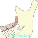 사랑니는 꼭 빼야 하나요? 이미지