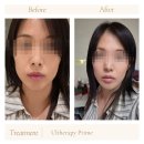 라임디자인 - 하남시 검단산로146번길 79-8 | 강남구청역피부과 울쎄라피프라임 200샷 후기, 심부볼 리프팅 당일 전후차이