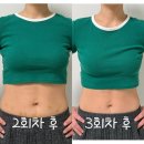 주생명의원 | 상상이 현실이되는 의원, 날씬한 허리라인을 상상하며 방문한 대전 복부지방분해주사 3회차 후기