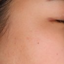 하늘체한의원 | [수원] 인계동 한의원 수원 편평사마귀 제거 하늘체한의원 내 돈 내산 후기 1탄