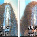 이안두피탈모 이미지