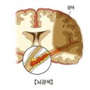 뇌졸중이란 이미지