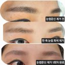 쌍용1차(아) | 미작뷰티 수지상현 : 눈썹반영구 제거 용인 기흥 처인구 문신제거 눈썹제거