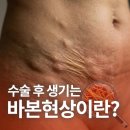 수술 후 살이 딱딱하게 뭉치는 바본현상(바이어본드)는 부작용일까요?