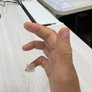 마디손정형외과병원 | 손가락 골절 수술 후기 4 – 새끼손가락 재활 과정...경과 사진 (서울대병원 정형외과, 핀고정술, 수술...