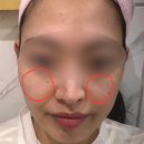 일상에서바로통하는엑셀기초+실무 | 건대피부과 홍조 기미 잡티 제거에 좋은 모공레이저 엑셀브이 플러스&amp;피코웨이 리얼 후기
