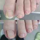 이화의원 | 강서 은평구 연신내 구파발역 불광동 진관동 발톱 무좀 레이저 치료 전문 병원 치료 후기 이화웃는세상의원