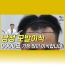 남성 모발이식3000모 가장 많이 이식합니다! 이미지