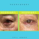 S성형외과의원 | 하안검재수술 안검외반 부작용 해결을 위한 방법 (강남 신사역 하안검 성형외과 전문의)