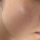 구구절절 피부 이야기 주사피부염 극복 후기. 완치 된거 맞겠지???