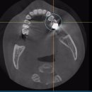 비바치과의원 | Dental CT 치과씨티를 이용한 치아사이 충치찾기 , 어금니 치아색상 무엇이 문제인가? 투명도!