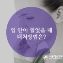 입 안이 헐었을 때, 대처방법 이미지