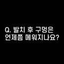 꼬집