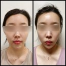 청담피부과 온웨이브 소프웨이브 온다리프팅 효과 본 후기 feat. 통증, 가격