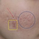 인제한의원 | 부산 여드름흉터치료 치료 전후 비교(Feat. 새살침+새살약침+피코프락셀+RF니들+레가토 복합치료 효과후기)