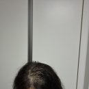 여자 탈모 그로우턴앰플 내돈내산 1.5통 사용 후기