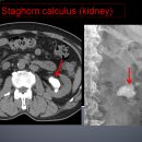 Staghorn calculus (kidney)) 이미지
