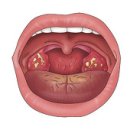 아데노이드의 비대를 동반한 편도의 비대 (Hypertrophy Of Tonsils With Hypertrophy Of Adenoids) 이미지