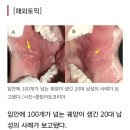 "입안의 궤양 126개가" 헤르페스인 줄 알았는데 '뜻밖의 질환' 이미지