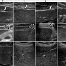 Re:간경변의 진단 이미지