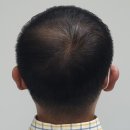 에프앤디별내플레이스 | 남양주모발생장 탈모 고민 에프앤디별내플레이스가 구세주예요